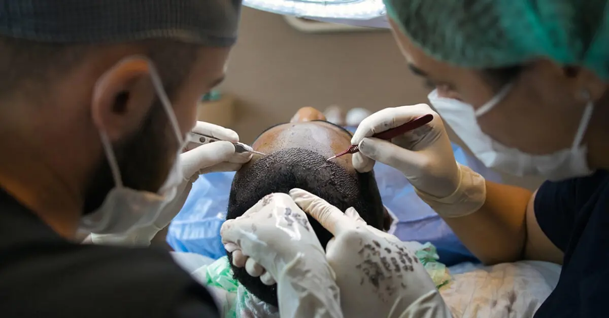 hair transplant, treatment, surgery, procedure, scalp, head, dermatology, hair transplant, hair transplant, hair transpl